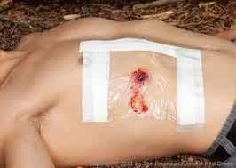 ECT4Health- Nurse/Paramedic Education - Open Pneumothorax 3 sided dressing  out Occlusive dressing in ... When a penetrating chest injury occurs, there  exists the possibility that the wound communicates with the pleura. This