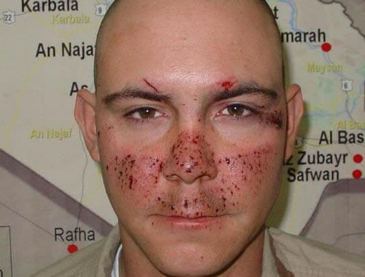 Figure 2. Maintain high index of suspicion for eye trauma injury even if not obvious. Photo credit: COL (Ret) Thomas H. Mader, MD.