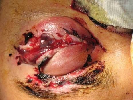 Figure 3. Open globe with eyelid laceration secondary to rubber pellets from nonlethal grenade explosion. Photo credit: LTC Won Kim.