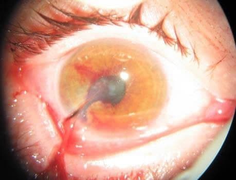 Figure 4. Corneal laceration and eyelid laceration. Photo credit: COL Mark Reynolds.