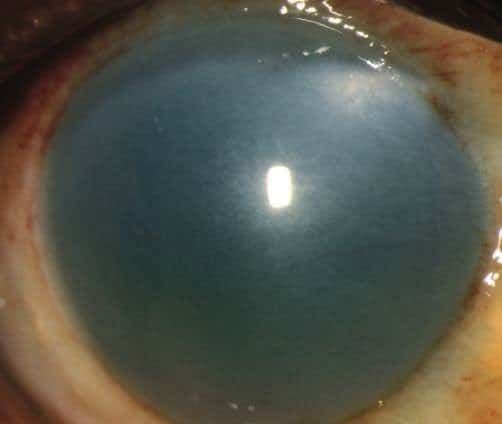 Figure 11. Alkali burn with corneal opacification and blanching of conjunctiva. Photo credit: Wills Eye Manual 7th Edition.