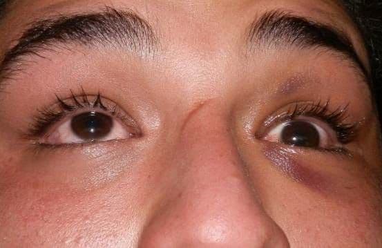 Figure 14. Entrapment of left inferior rectus muscle from left orbital floor fracture. Patient is unable to look upward with left eye. Photo credit: Maj Brett Davies.