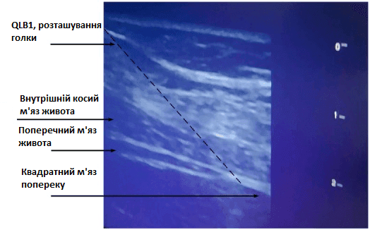 QL блокада -3.png