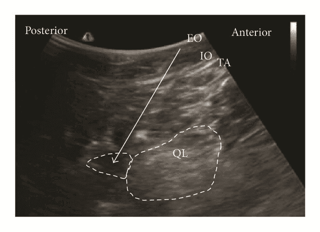 QL блокада - 6б.png