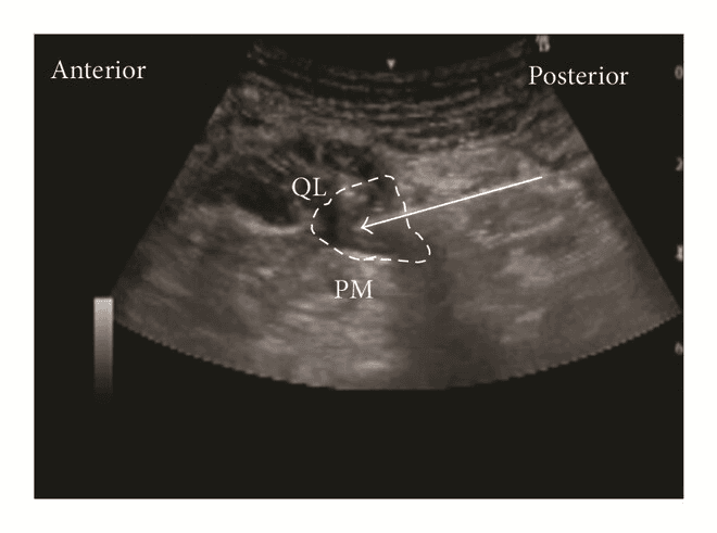 QL блокада - 9б.png